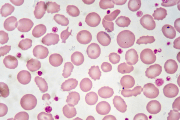 FASENRA Demonstrates Breakthrough Results in Rare Eosinophilic Disease: NATRON Trial Shows Promise for Hypereosinophilic Syndrome Patients