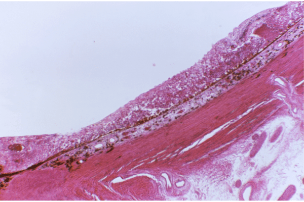 NHS Fast-Tracks Glofitamab, Expanding Curative Options for Aggressive Lymphoma