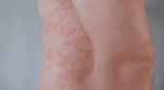 Litifilimab Shows Promise in Phase 2 Trial for Cutaneous Lupus