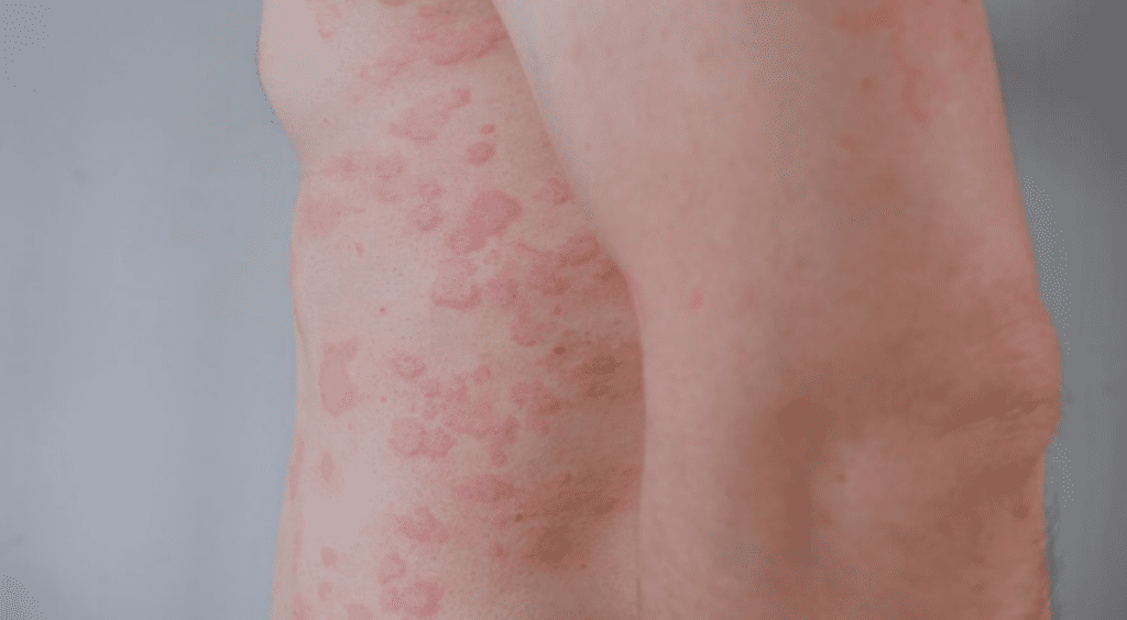 Litifilimab Shows Promise in Phase 2 Trial for Cutaneous Lupus