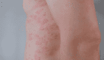 Enanta Begins First-in-Human Trial of Oral KIT Inhibitor for Chronic Urticaria