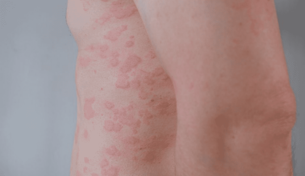 Enanta Begins First-in-Human Trial of Oral KIT Inhibitor for Chronic Urticaria