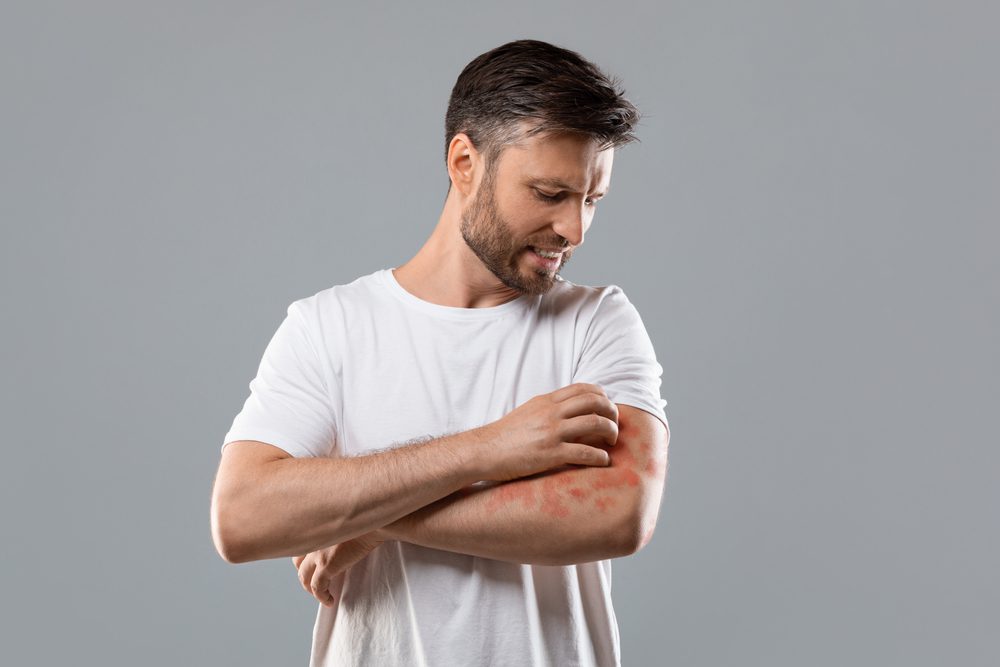 FDA Expands Approval of Roflumilast Cream (Zoryve) to Younger Children with Plaque Psoriasis