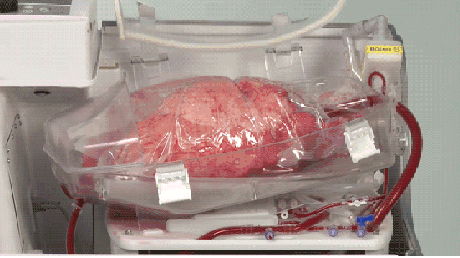 FDA Clears TorEx Lung Perfusion System, Expanding Options for Donor Lung Assessment