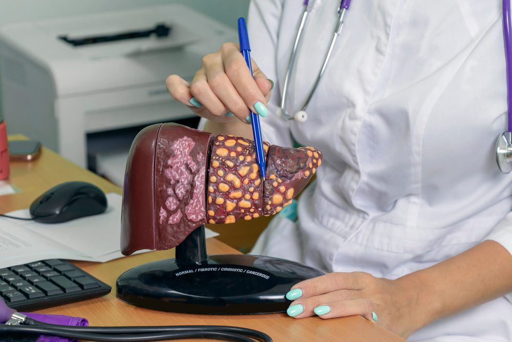 Cheryl’s Liver Cancer Story