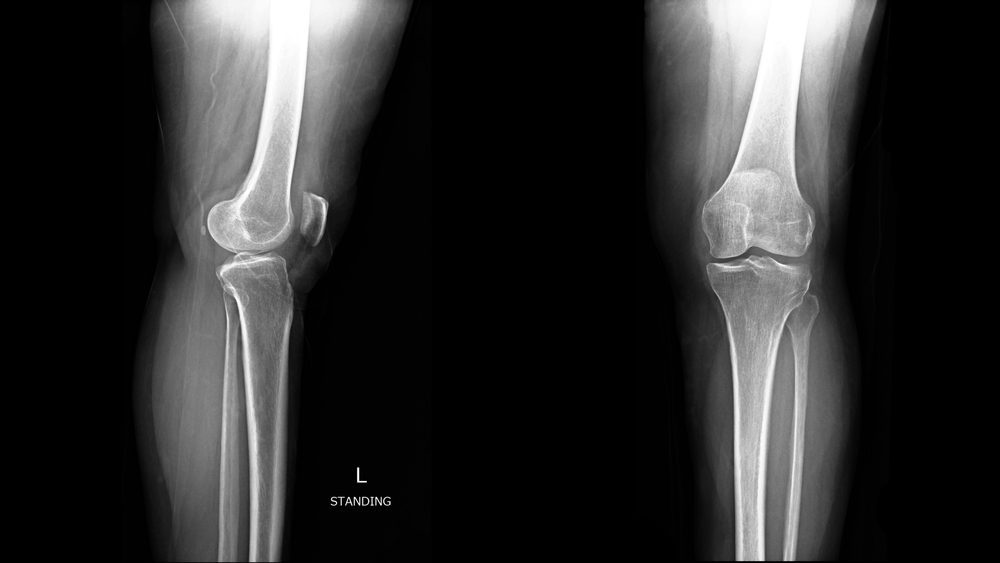 LEVI-04 Shows Promise as a Novel Non-Opioid Therapy for Knee Osteoarthritis in Phase 2 Trial