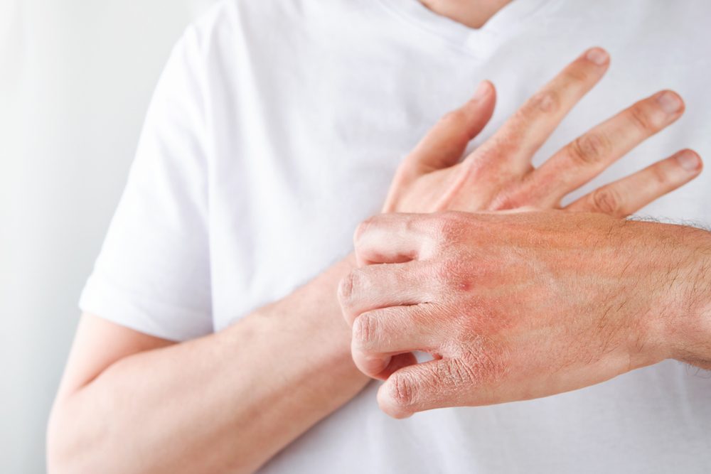 Health Canada Prioritizes Review of FILSUVEZ for EB-Related Wounds