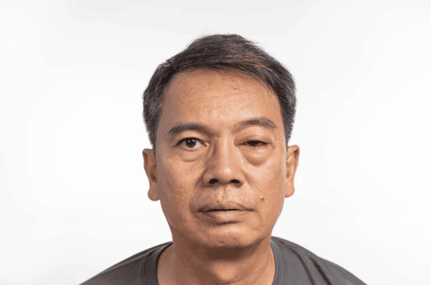 BioCryst Wins Japanese Approval for Pediatric Use of ORLADEYO in Hereditary Angioedema