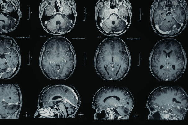 New PTEN Research Could Help Predict Cancer Risk in Rare Genetic Syndrome