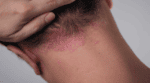 FDA Grants Priority Review to Takeda’s Psoriasis Candidate Zasocitinib